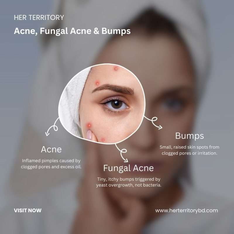 Acne, Fungal Acne & Bumps